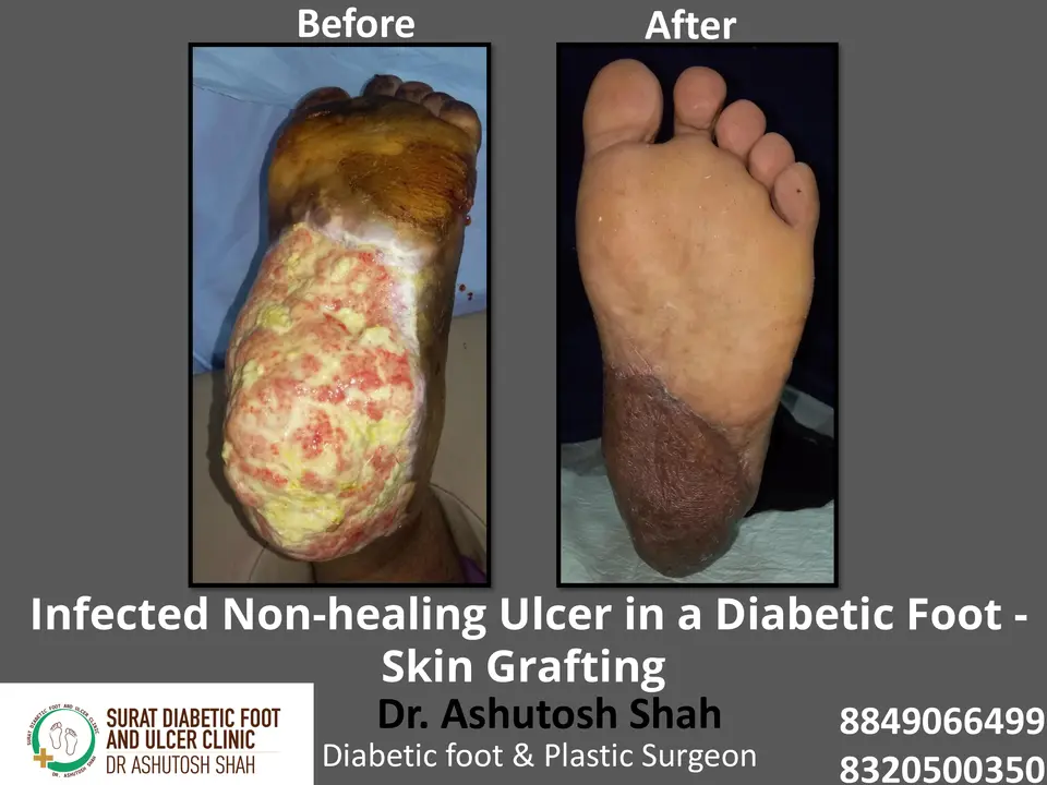 Diabetic Foot  PPT 3 checked by sir.pptx-12.webp